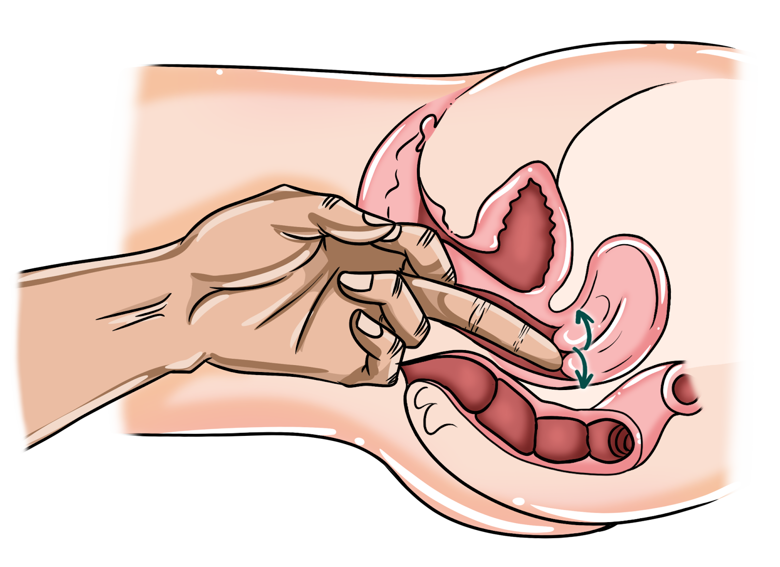 Technique #21 – Cervix Flicker