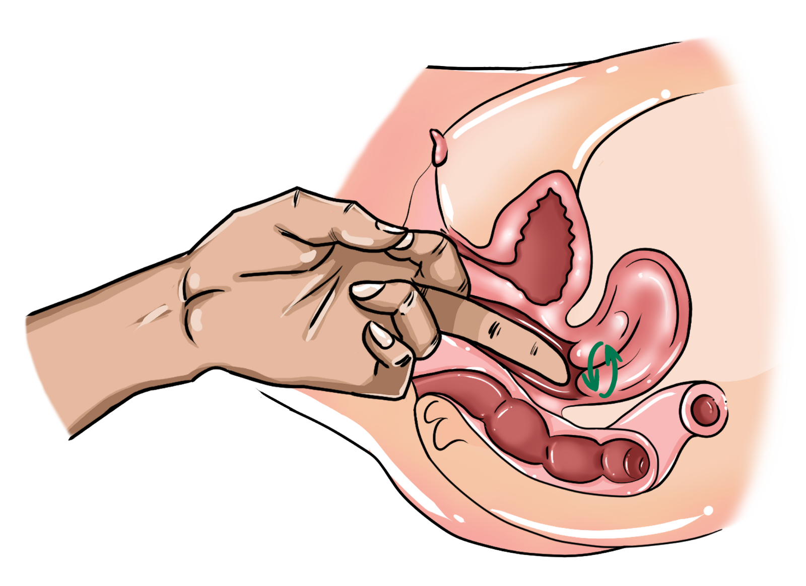 Technique #8 – Cervix Twirl