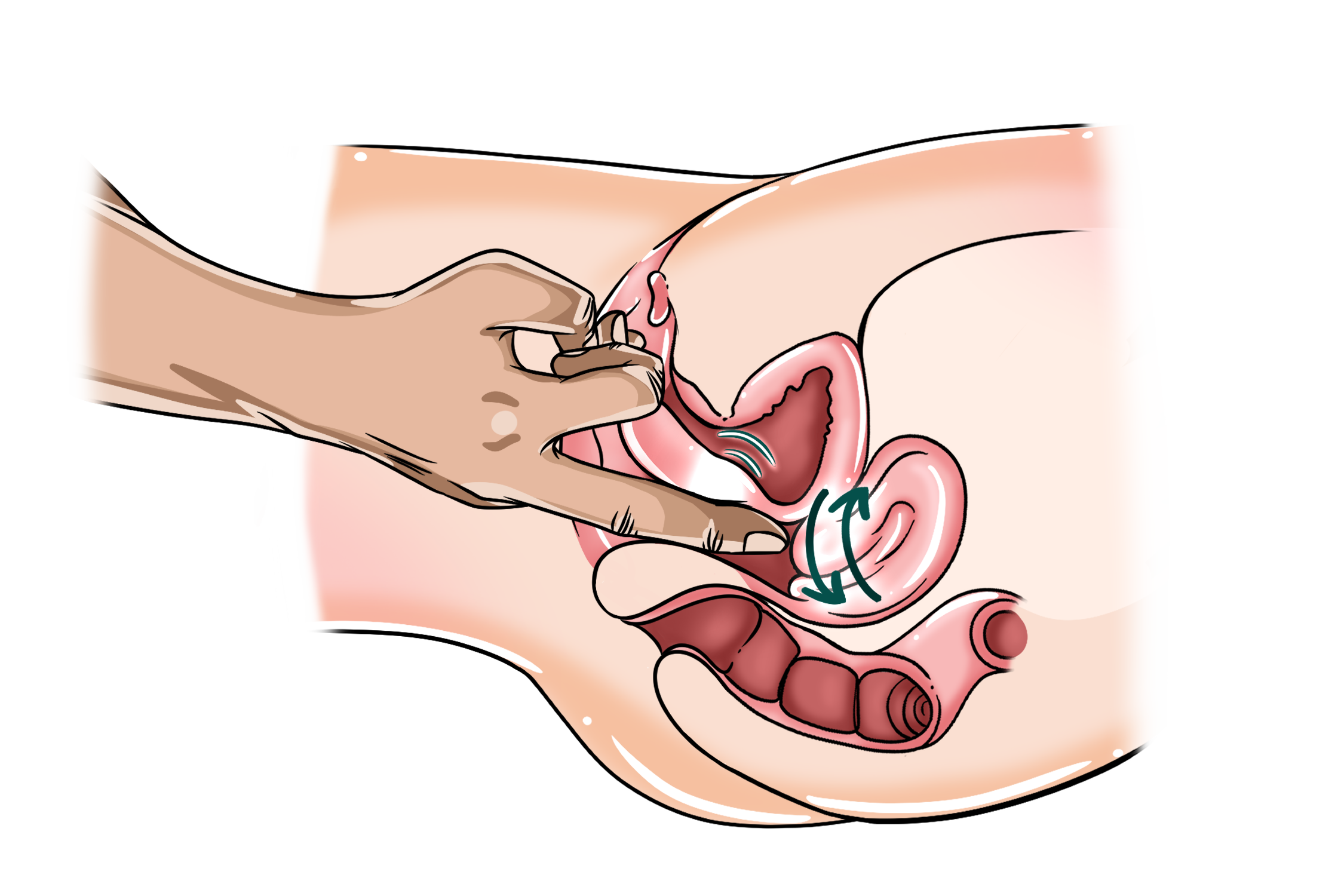 Technique #6 – G&A Wiggle G-spot massage diagram showing one finger extending toward the anterior fornix, with arrows indicating movement.