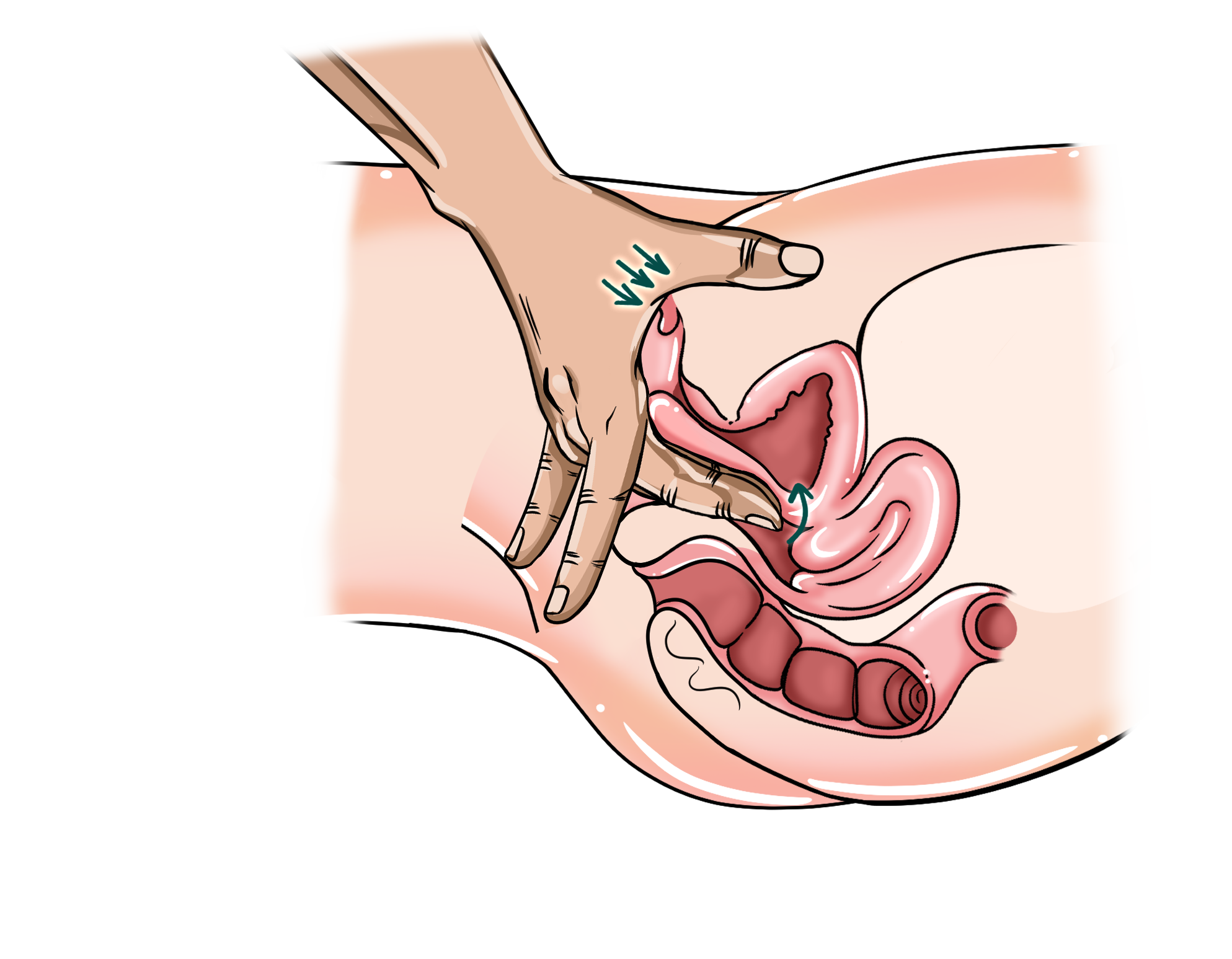 Technique #9 – G&C Hug G-spot massage diagram showing a curled finger inside and the thumb pressing externally with the same hand.
